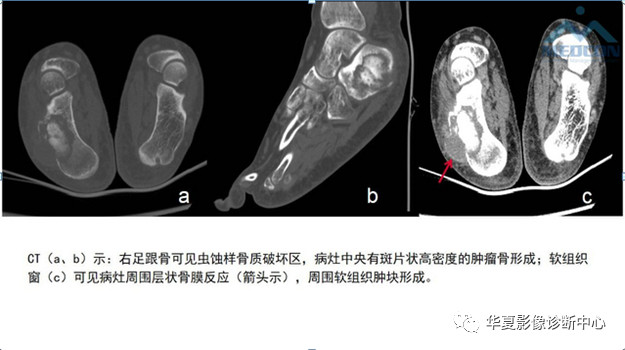 跟骨病变都在这里，赶快收藏吧！