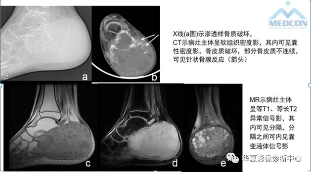 跟骨病变都在这里，赶快收藏吧！