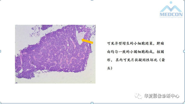 跟骨病变都在这里，赶快收藏吧！