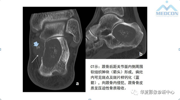 跟骨病变都在这里，赶快收藏吧！