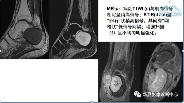 跟骨病变都在这里，赶快收藏吧！