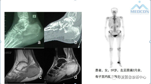 跟骨病变都在这里，赶快收藏吧！