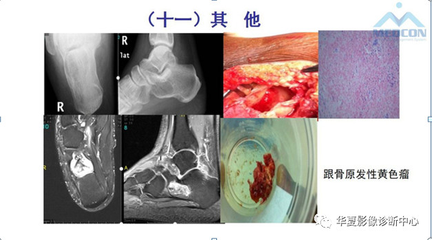 跟骨病变都在这里，赶快收藏吧！