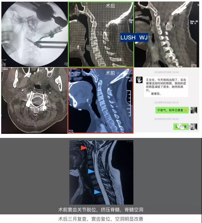 扁桃体疝和脊髓空洞是脊髓的保护垫