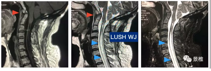 扁桃体疝和脊髓空洞是脊髓的保护垫