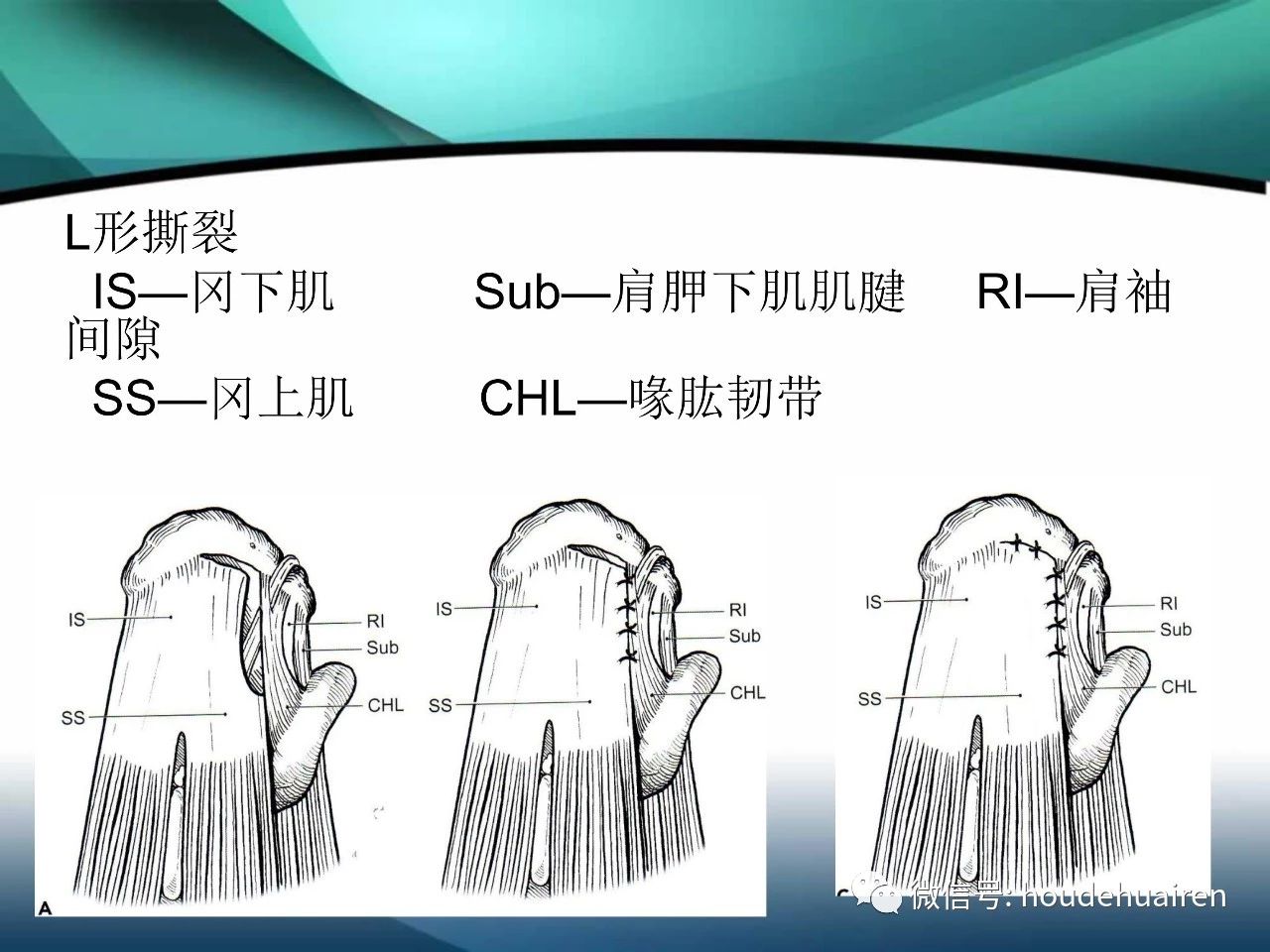 肩袖撕裂的诊断及治疗方法，看这篇就够了！