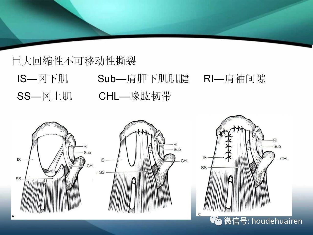 肩袖撕裂的诊断及治疗方法，看这篇就够了！