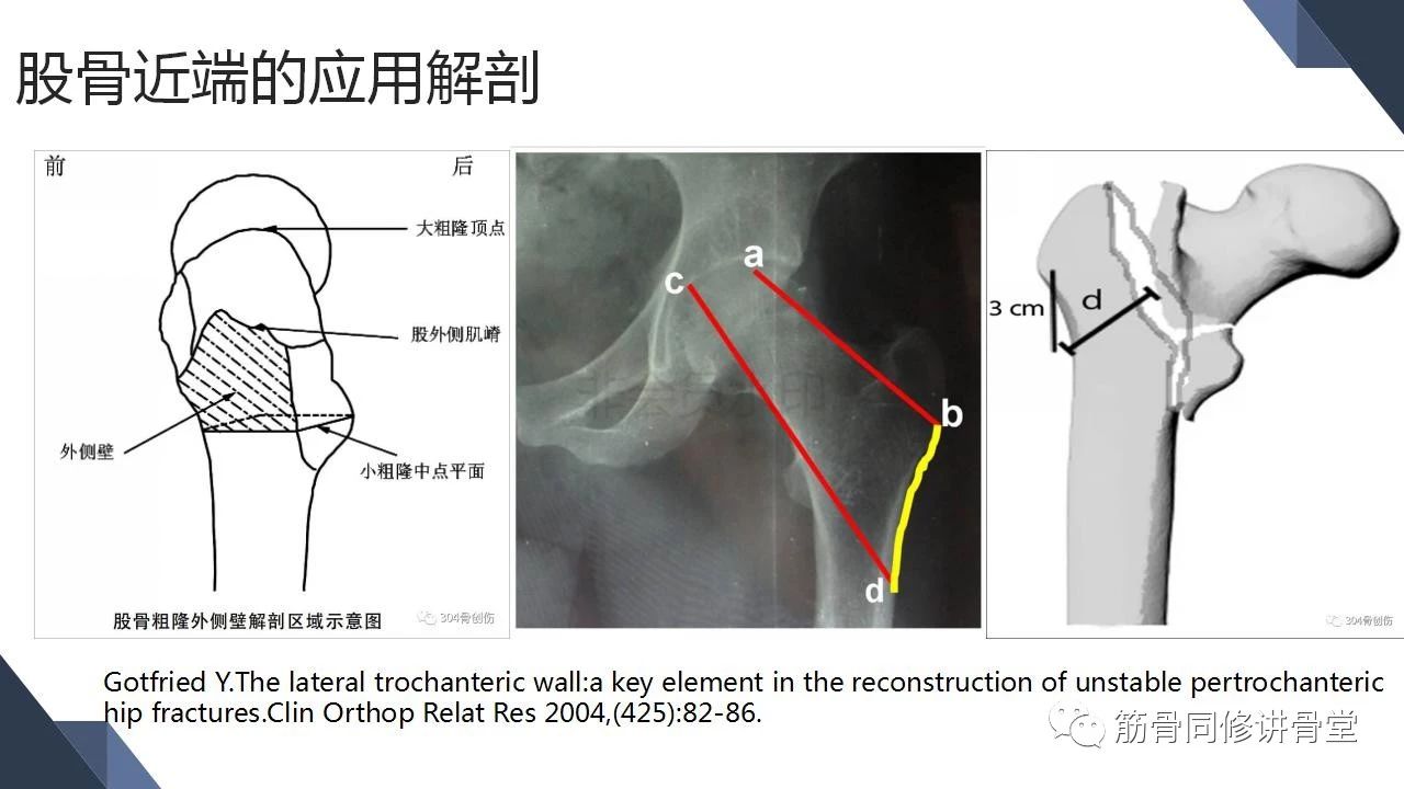 合并大转子冠状位骨折的股骨近端骨折的治疗