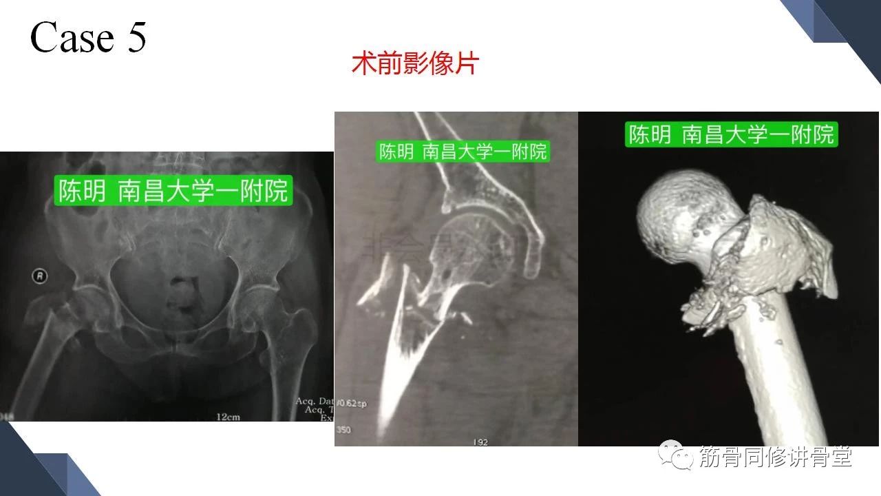 合并大转子冠状位骨折的股骨近端骨折的治疗