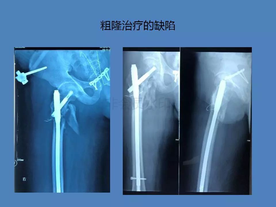 骨水泥技术——治疗开放骨盆多发伤感染