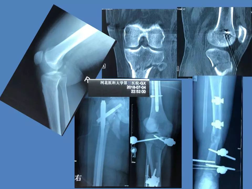 骨水泥技术——治疗开放骨盆多发伤感染