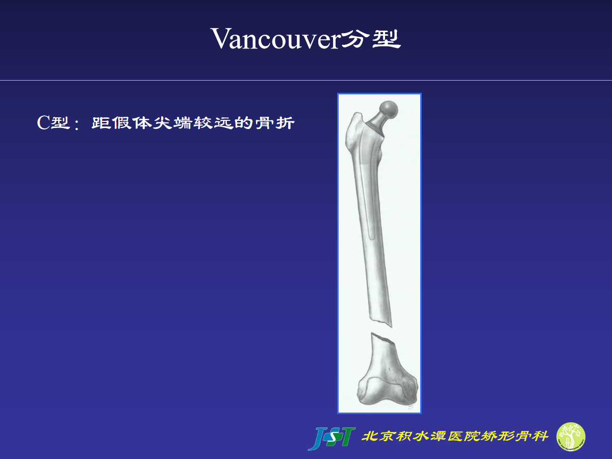 髋关节置换术后股骨假体周围骨折的诊治策略！
