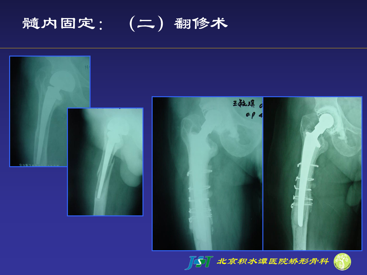 髋关节置换术后股骨假体周围骨折的诊治策略！