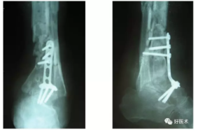 骨折内固定AO治疗原则，好文值得收藏！ - 好医术早读文章- 好医术-赋能 
