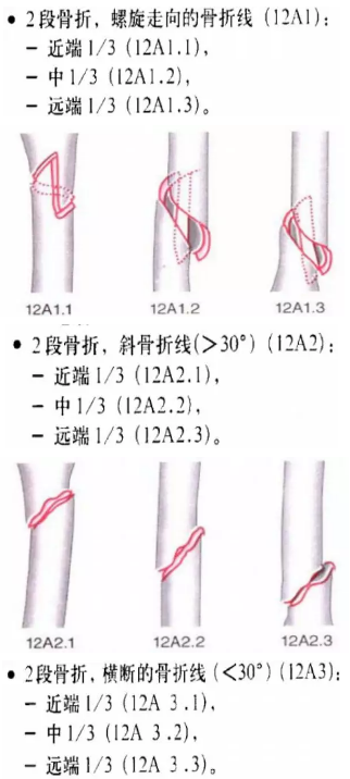 骨科常见骨折分型汇总，值得收藏备用！