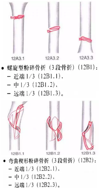 骨科常见骨折分型汇总，值得收藏备用！