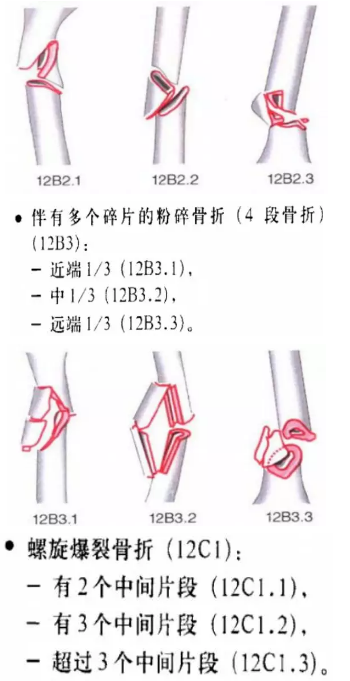 骨科常见骨折分型汇总，值得收藏备用！