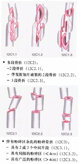 骨科常见骨折分型汇总，值得收藏备用！