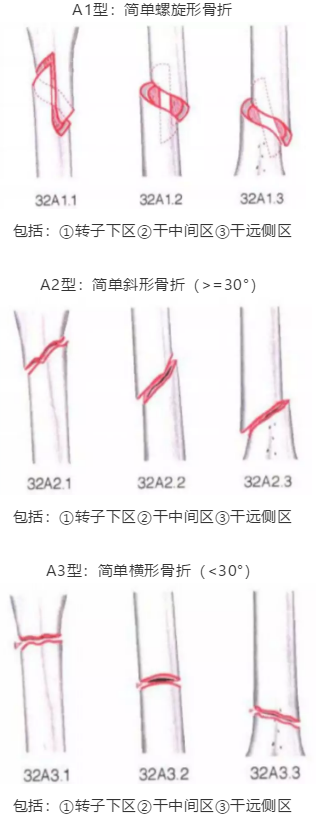 骨科常见骨折分型汇总，值得收藏备用！