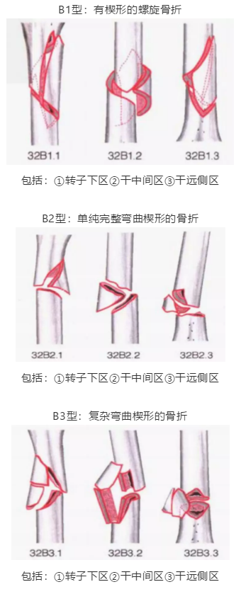 骨科常见骨折分型汇总，值得收藏备用！