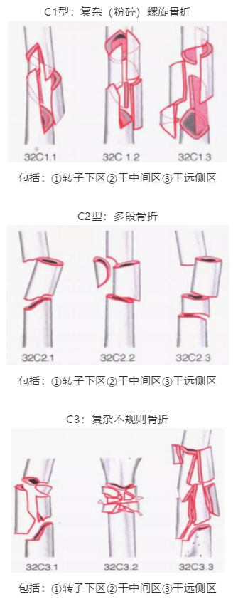 骨科常见骨折分型汇总，值得收藏备用！