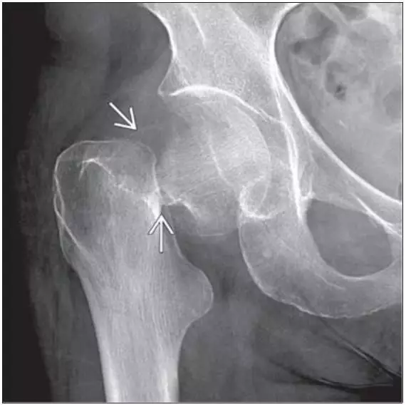 股骨解剖图x线图片