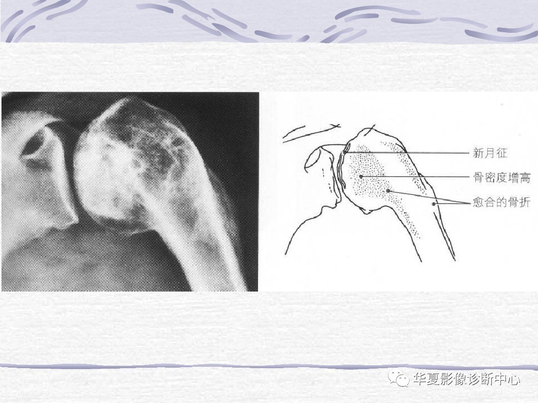 骨关节创伤影像学诊断思路和技巧