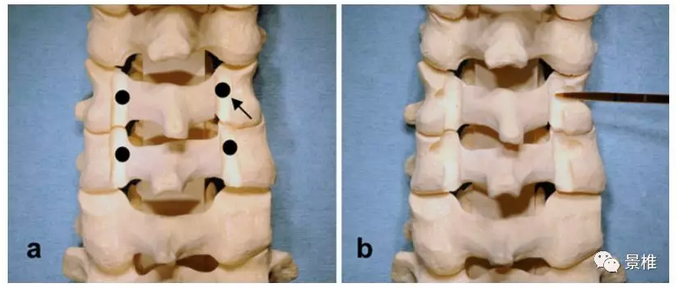颈椎椎弓根螺钉打法图片