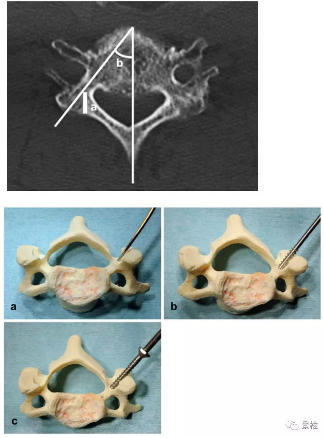 颈椎椎弓根螺钉打法图片
