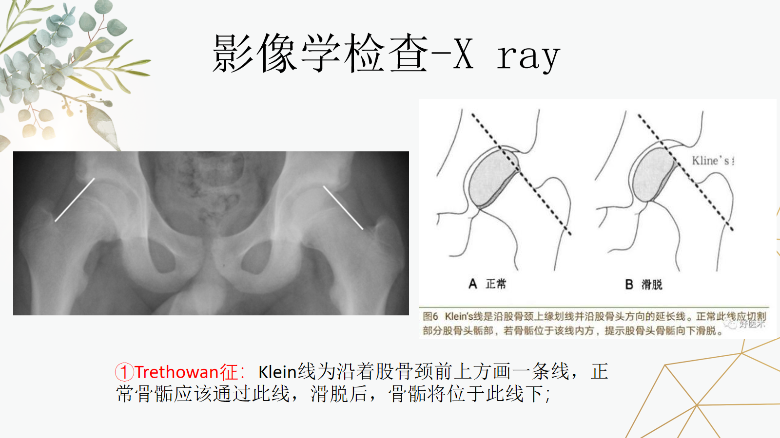 关于股骨头骨骺滑脱的诊治策略，这篇课件我打满分！