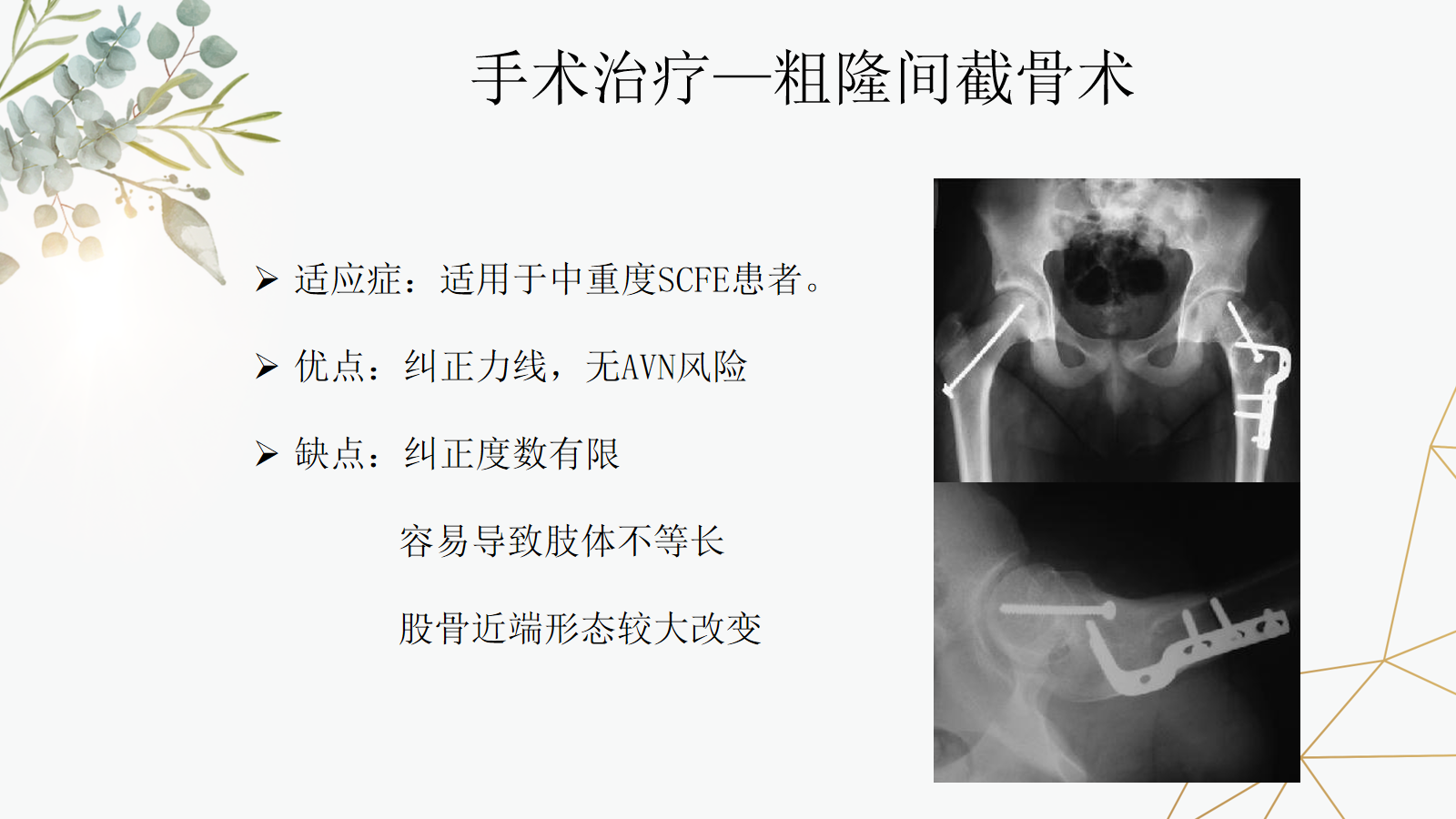 关于股骨头骨骺滑脱的诊治策略，这篇课件我打满分！