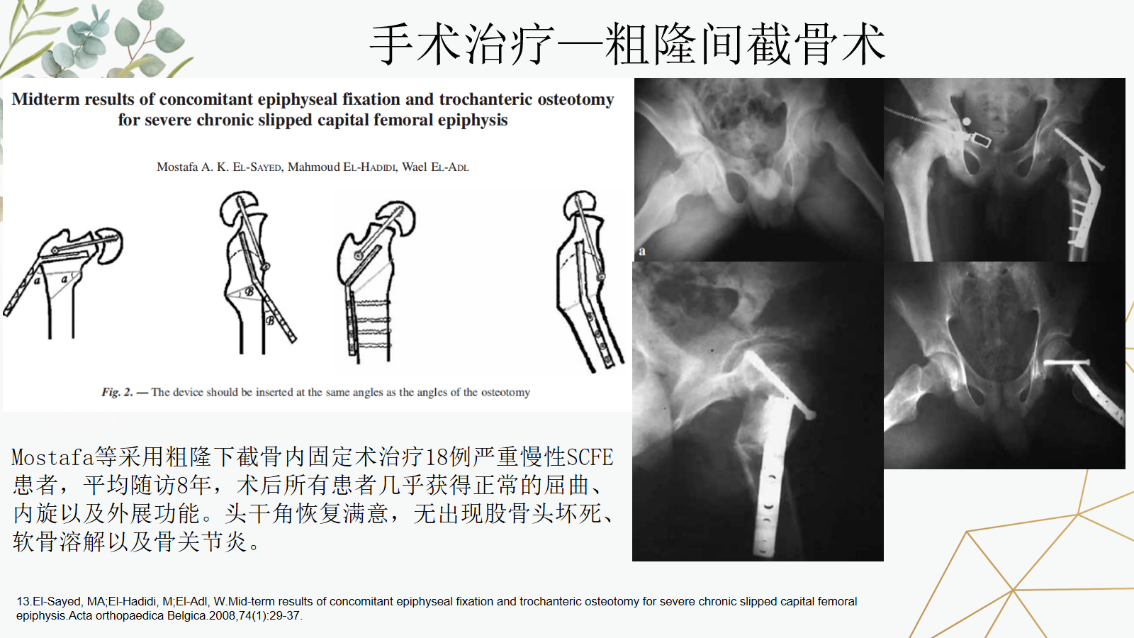 关于股骨头骨骺滑脱的诊治策略，这篇课件我打满分！