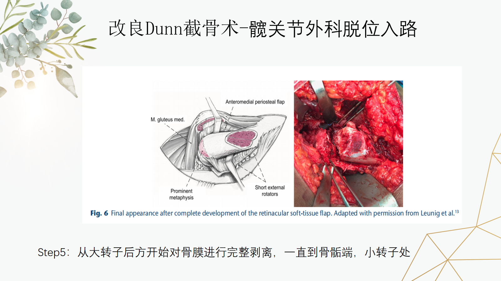 关于股骨头骨骺滑脱的诊治策略，这篇课件我打满分！