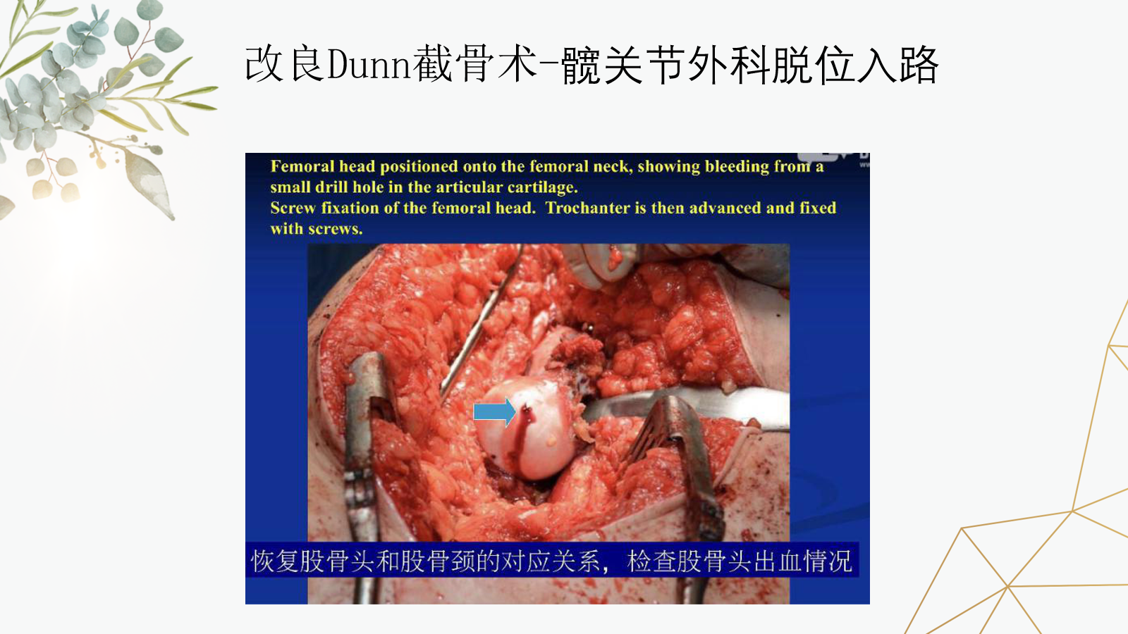 关于股骨头骨骺滑脱的诊治策略，这篇课件我打满分！