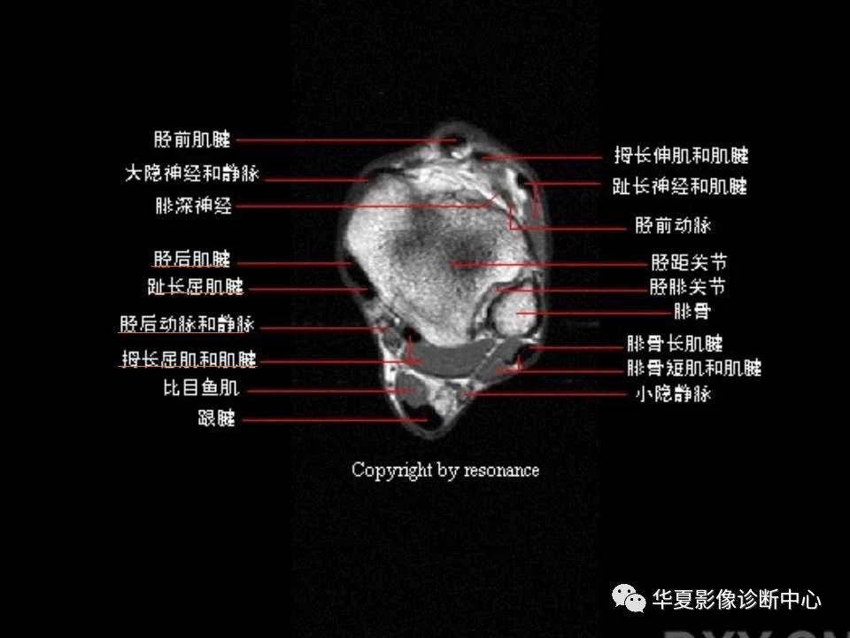 一文详解：踝关节MRI解剖及常见损伤类型