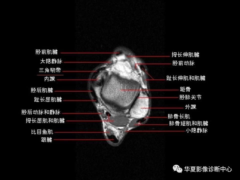 一文详解：踝关节MRI解剖及常见损伤类型