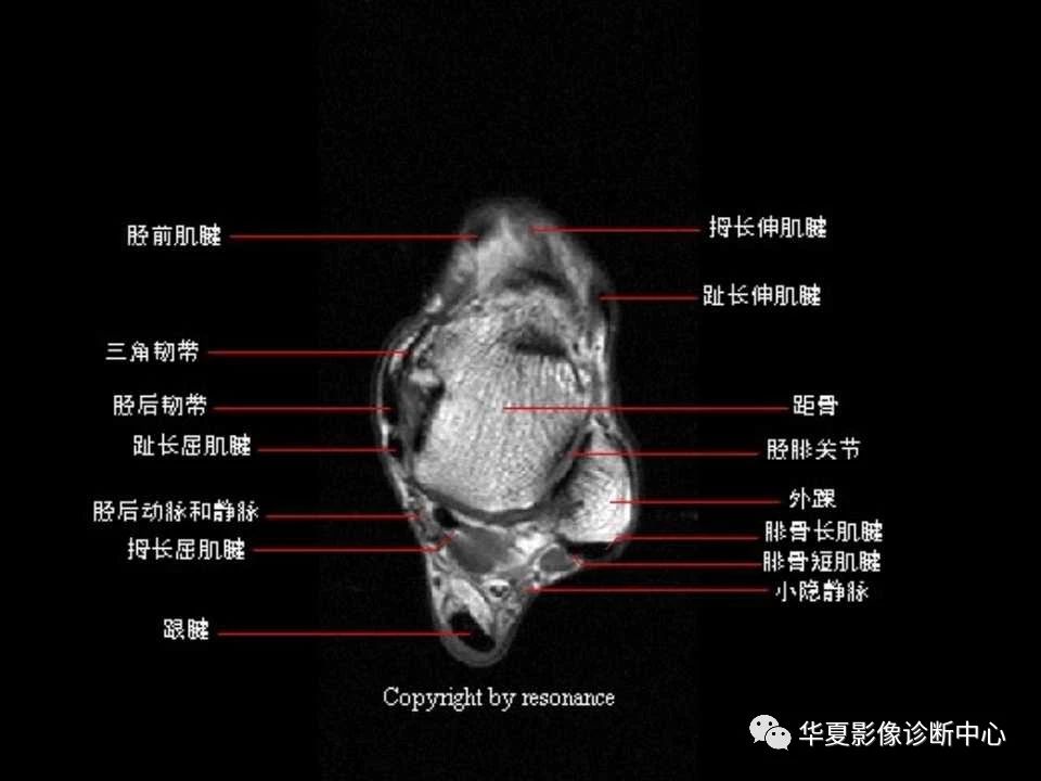 一文详解：踝关节MRI解剖及常见损伤类型