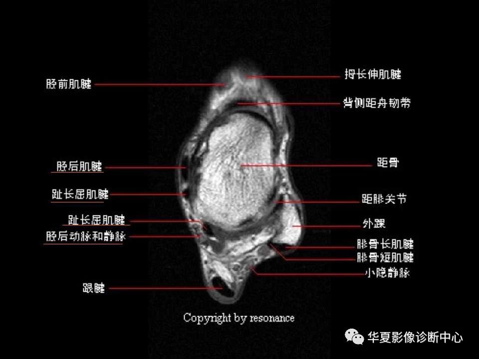 一文详解：踝关节MRI解剖及常见损伤类型