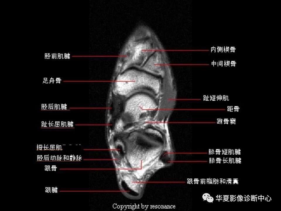 一文详解：踝关节MRI解剖及常见损伤类型