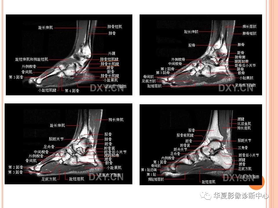 一文详解：踝关节MRI解剖及常见损伤类型