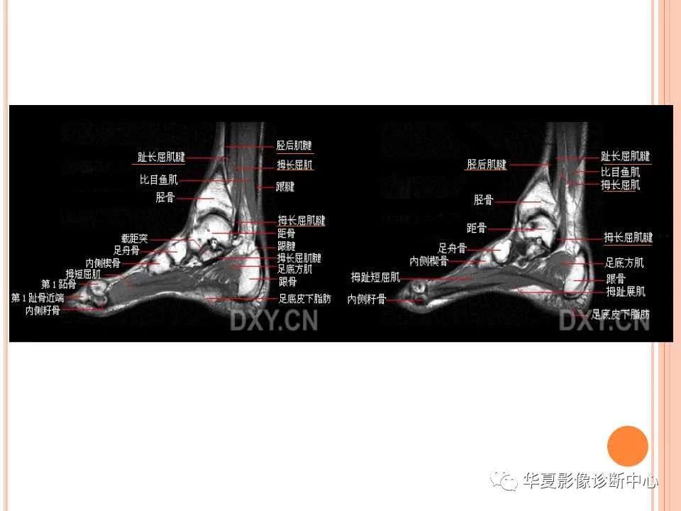 一文详解：踝关节MRI解剖及常见损伤类型