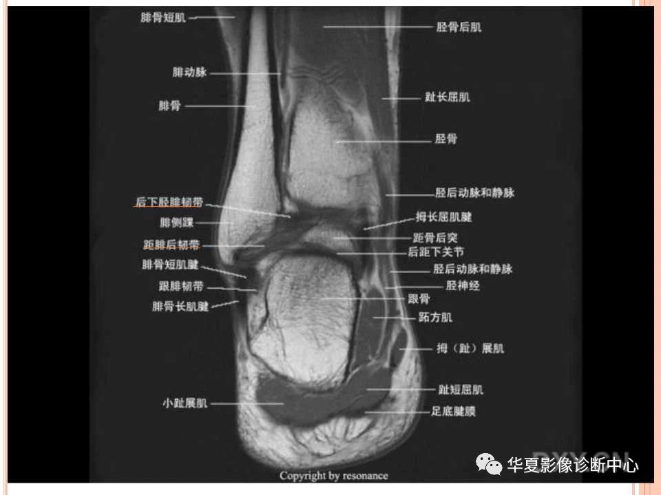 一文详解：踝关节MRI解剖及常见损伤类型