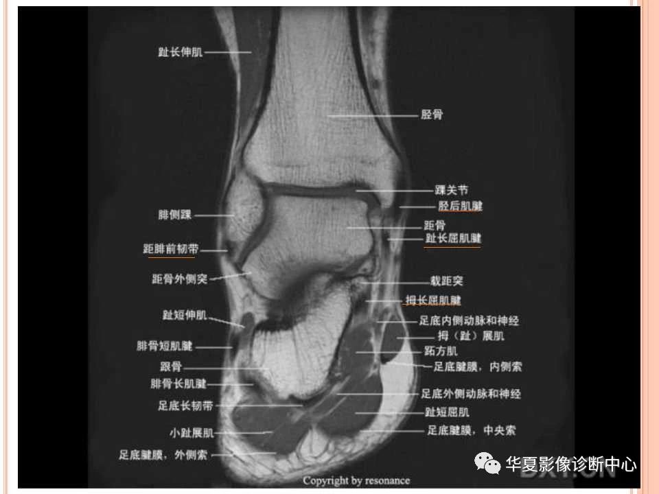 一文详解：踝关节MRI解剖及常见损伤类型