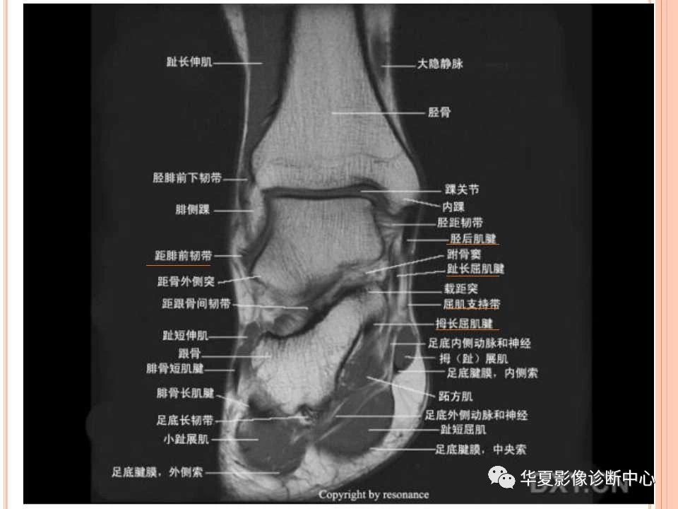 一文详解：踝关节MRI解剖及常见损伤类型