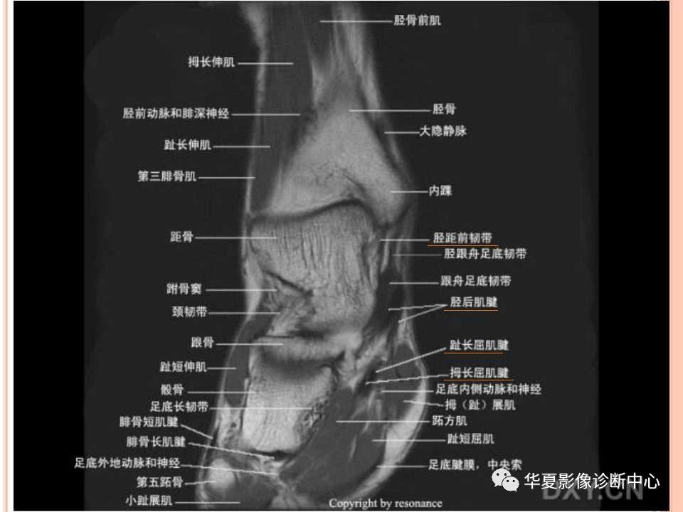 一文详解：踝关节MRI解剖及常见损伤类型