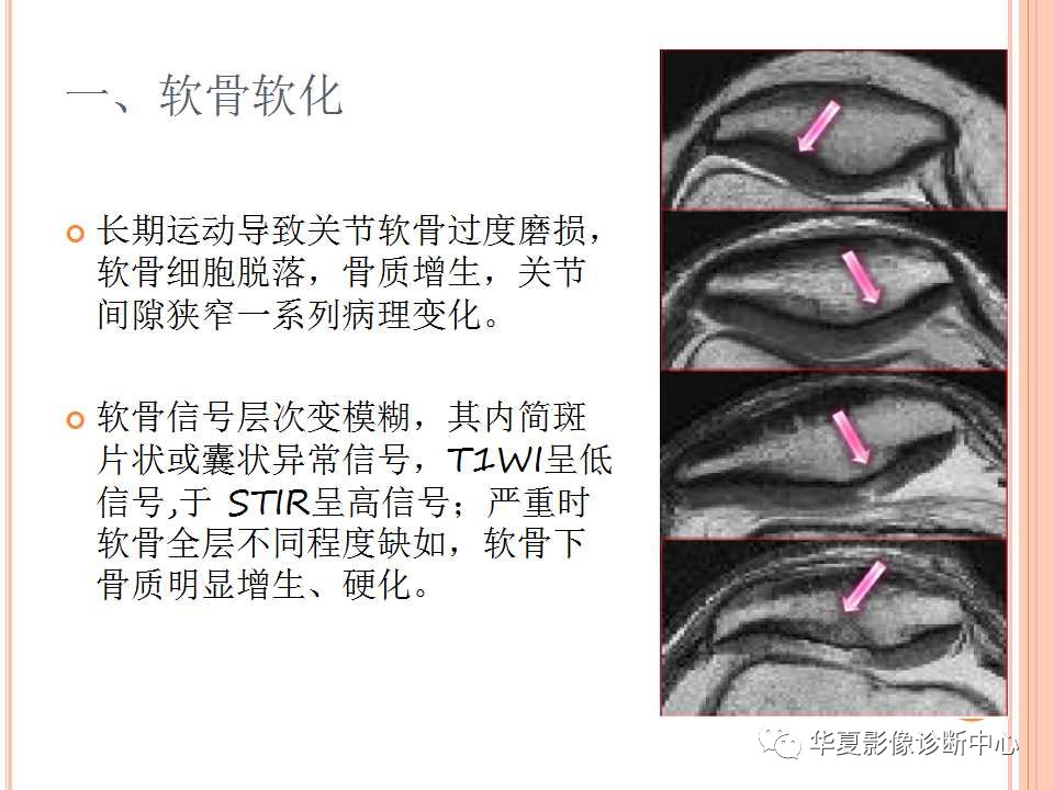 一文详解：踝关节MRI解剖及常见损伤类型