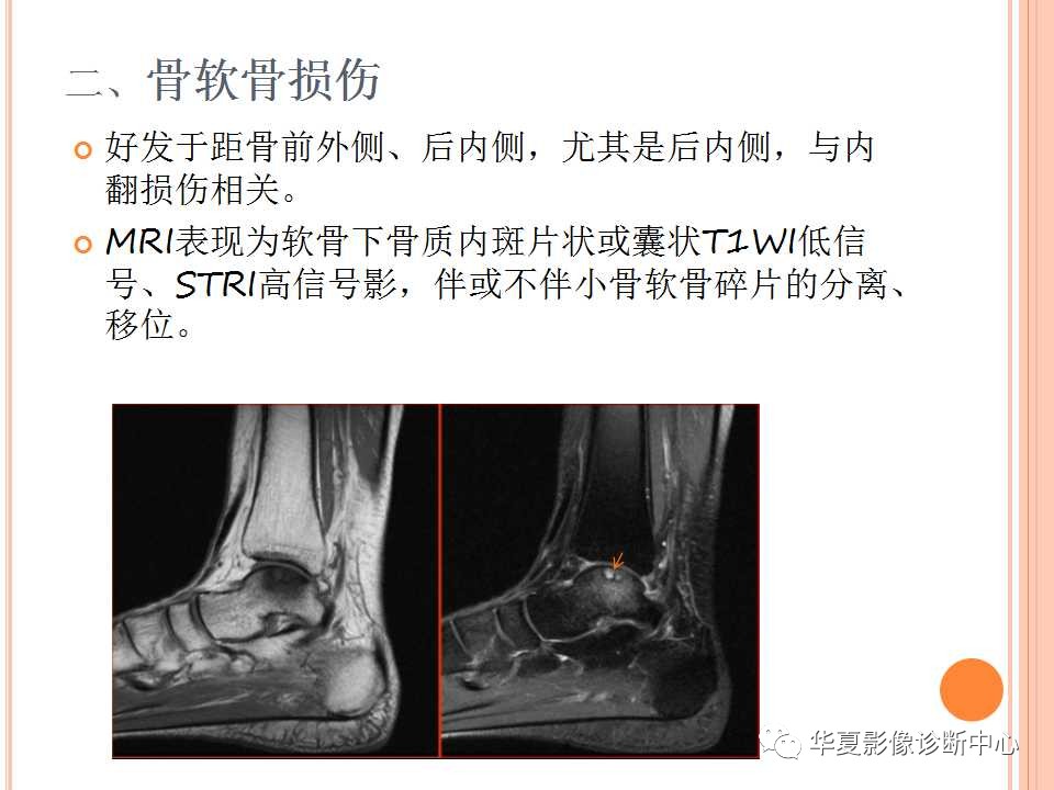 一文详解：踝关节MRI解剖及常见损伤类型