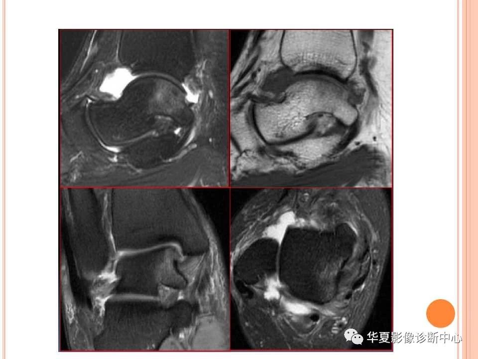 一文详解：踝关节MRI解剖及常见损伤类型