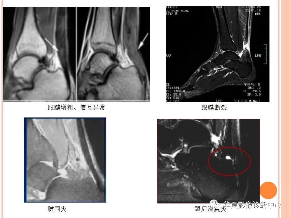 一文详解：踝关节MRI解剖及常见损伤类型