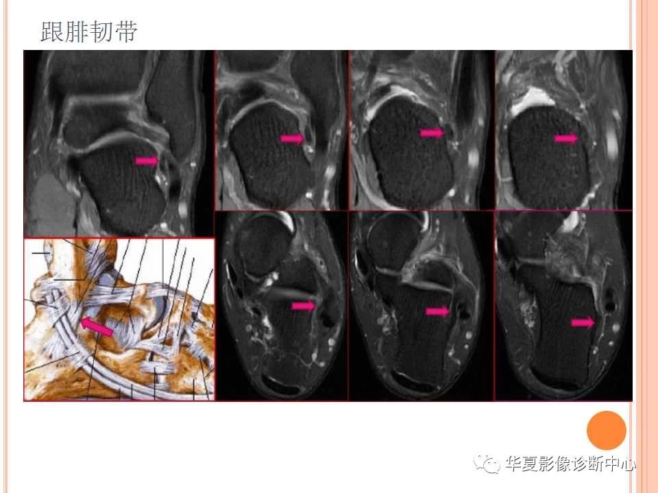 一文详解：踝关节MRI解剖及常见损伤类型